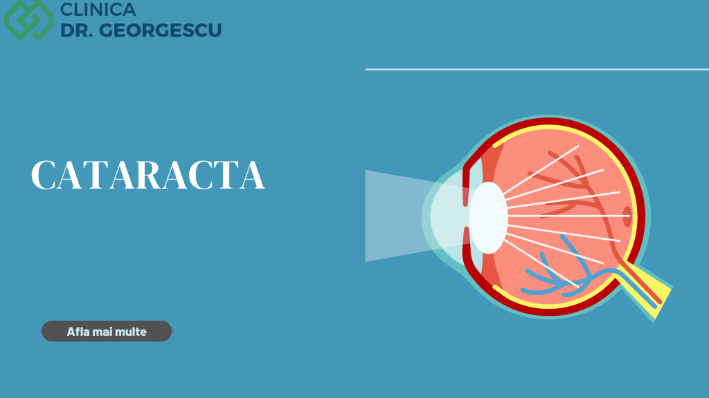Cataracta - Clinica Dr. Georgescu Pitesti
